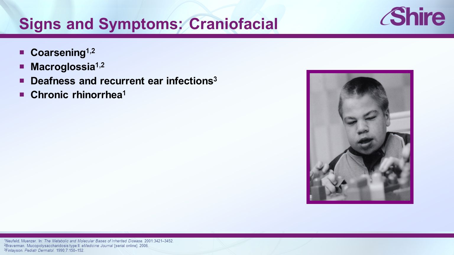 Signs and Symptoms: Craniofacial  Coarsening 1,2  Macroglossia 1,2  Deafness and recurrent ear infections 3  Chronic rhinorrhea 1 1 Neufeld, Muenzer.