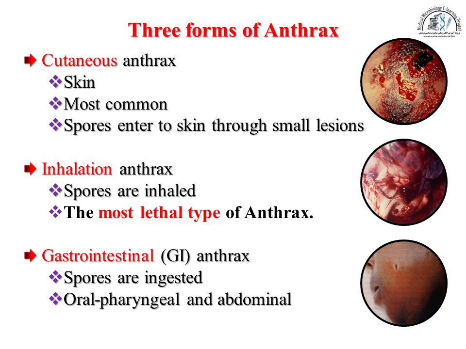 Three forms of Anthrax Cutaneous anthrax  Skin  Most common  Spores enter to skin through small lesions Inhalation anthrax  Spores are inhaled  The most lethal type of Anthrax.