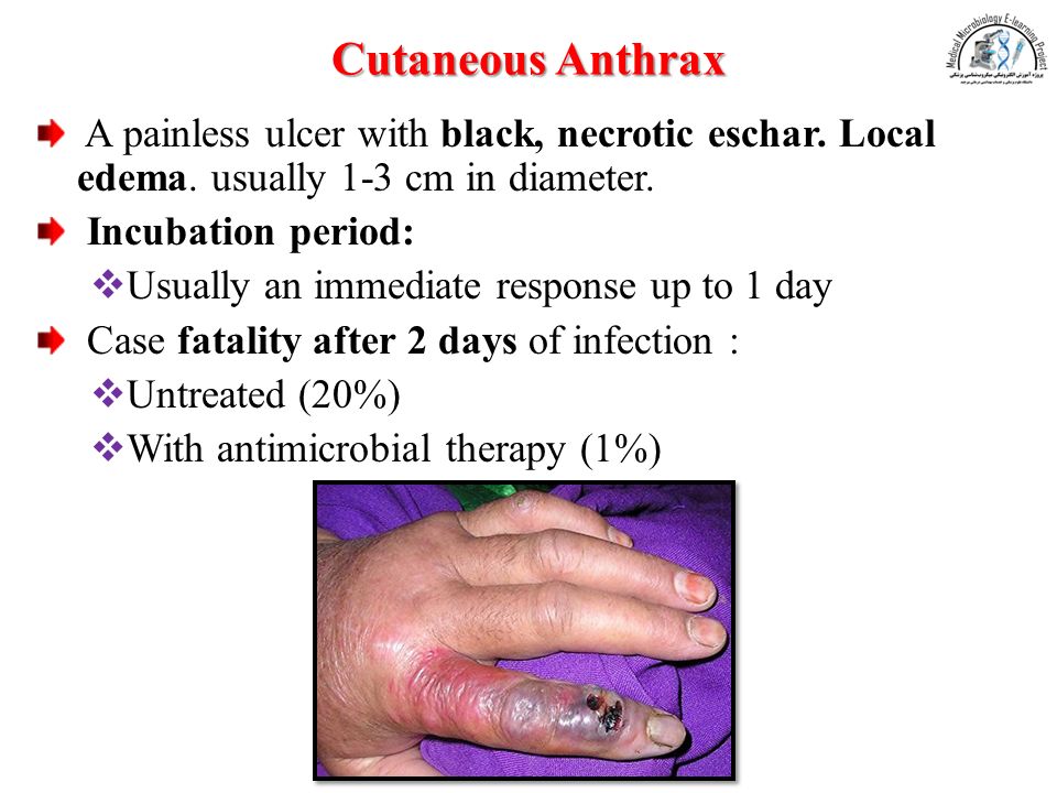 Cutaneous Anthrax A painless ulcer with black, necrotic eschar.