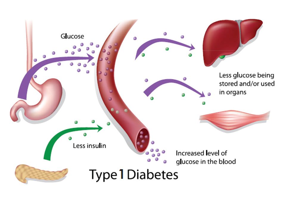 Cetosis diabetes tipo 1