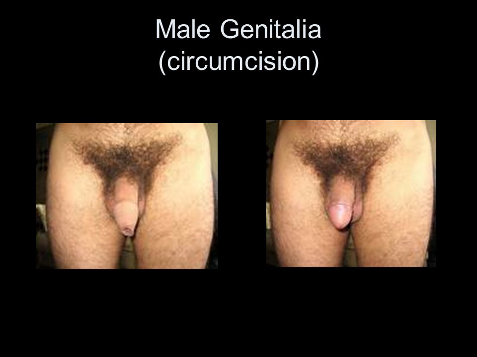 Male Genitalia (circumcision)