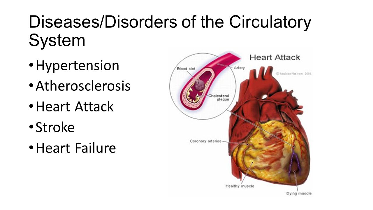 Diseases/Disorders of the Circulatory System Hypertension Atherosclerosis Heart Attack Stroke Heart Failure