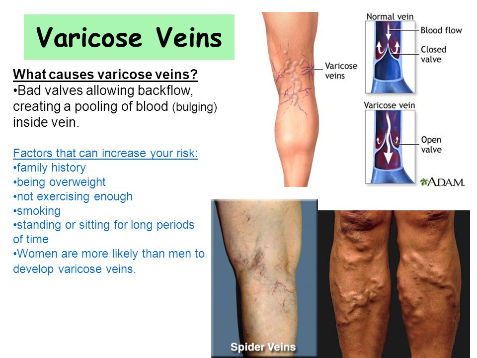 Thread veins and varicose veins