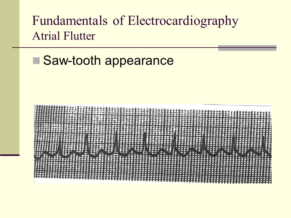 Fundamentals of Electrocardiography Atrial Flutter Saw-tooth appearance