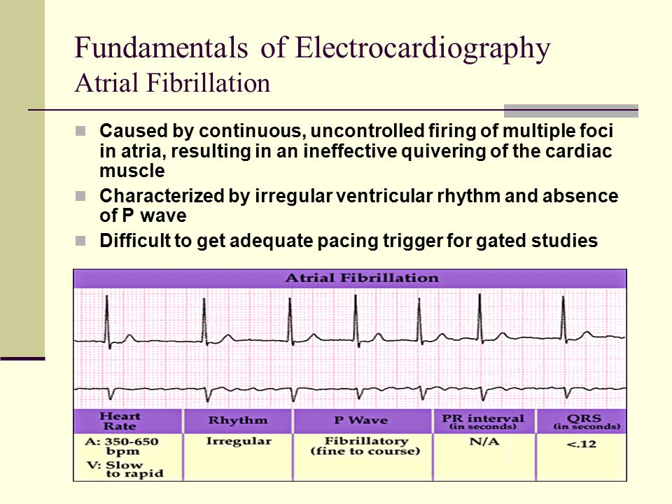 Fundamentals of Electrocardiography Atrial Fibrillation Caused by continuous, uncontrolled firing of multiple foci in atria, resulting in an ineffective quivering of the cardiac muscle Characterized by irregular ventricular rhythm and absence of P wave Difficult to get adequate pacing trigger for gated studies