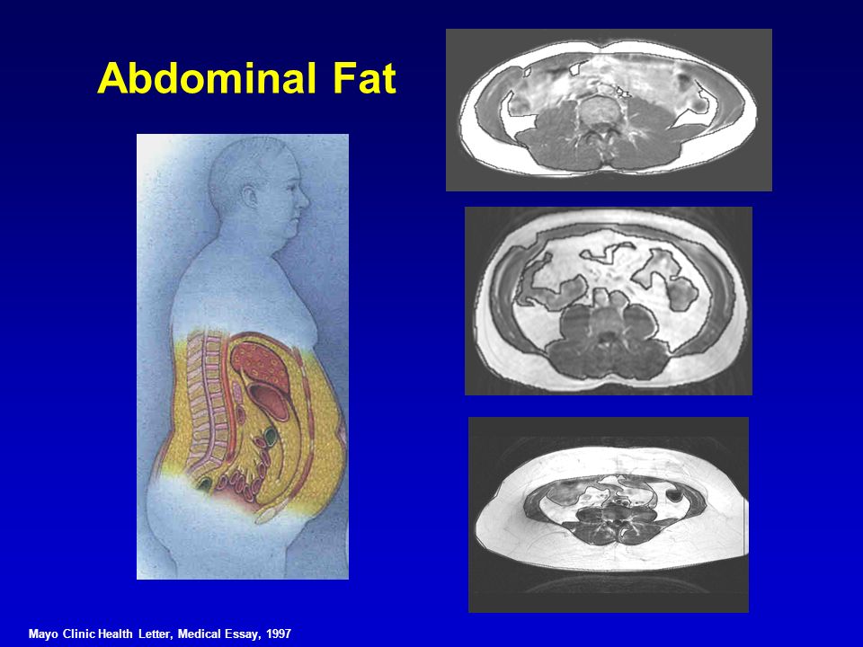 Epidemic of Obesity Mayo Clinic Health Letter Medical Essay ppt Epidemic of Obesity Mayo Clinic Health Letter Medical Essay ppt