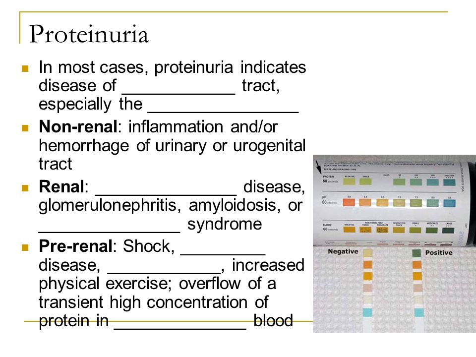 Proteinuria In most cases, proteinuria indicates disease of ____________ tract, especially the ________________ Non-renal: inflammation and/or hemorrhage of urinary or urogenital tract Renal: _______________ disease, glomerulonephritis, amyloidosis, or _______________ syndrome Pre-renal: Shock, _________ disease, ____________, increased physical exercise; overflow of a transient high concentration of protein in ______________ blood