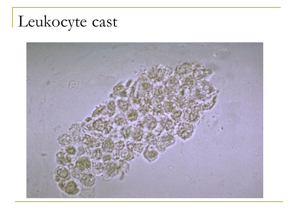 Leukocyte cast