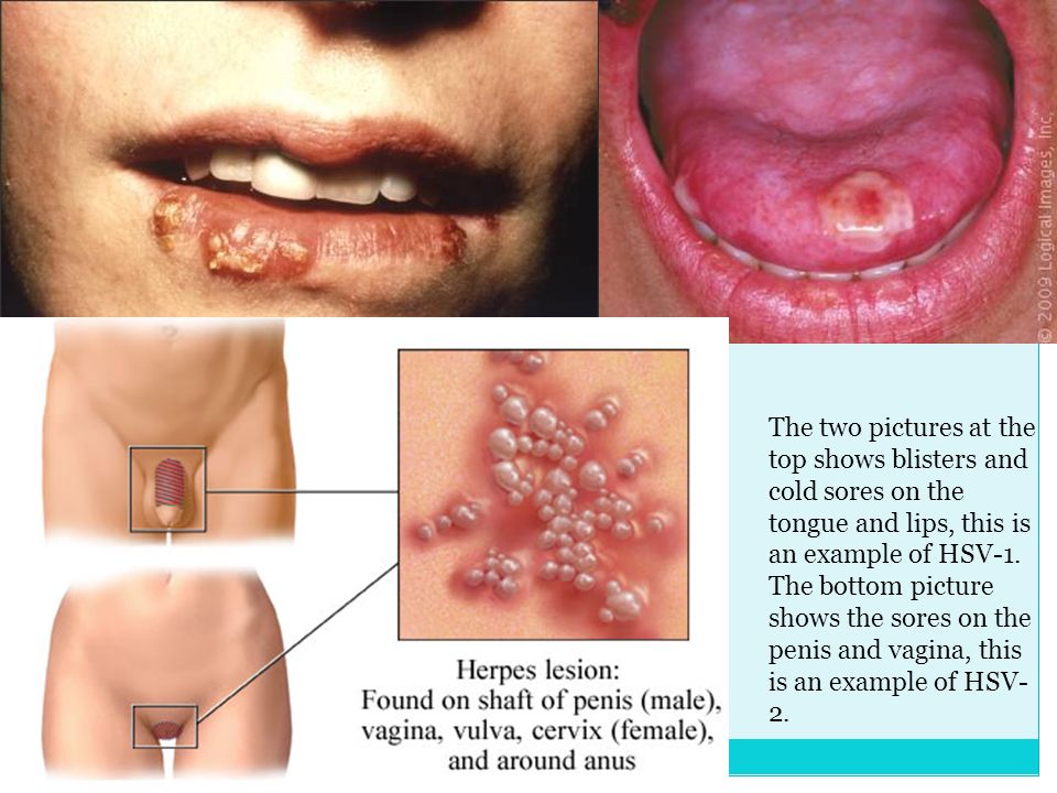 Types of HSV HSV-1: this type of herpes is the main cause of herpes infecti...