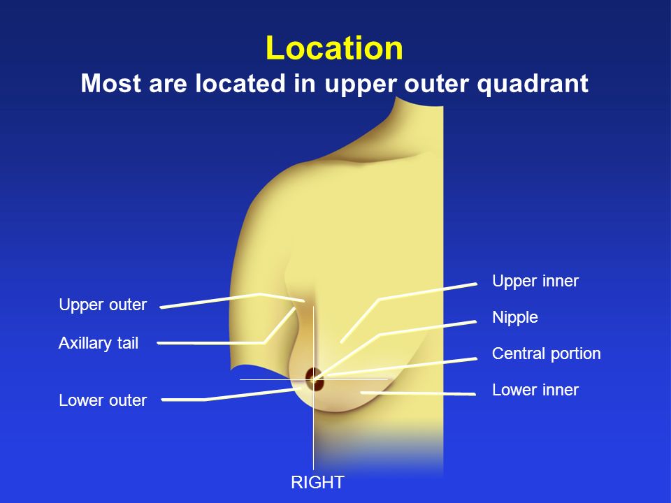 upper outer quadrant of the right breast Nudist camping california