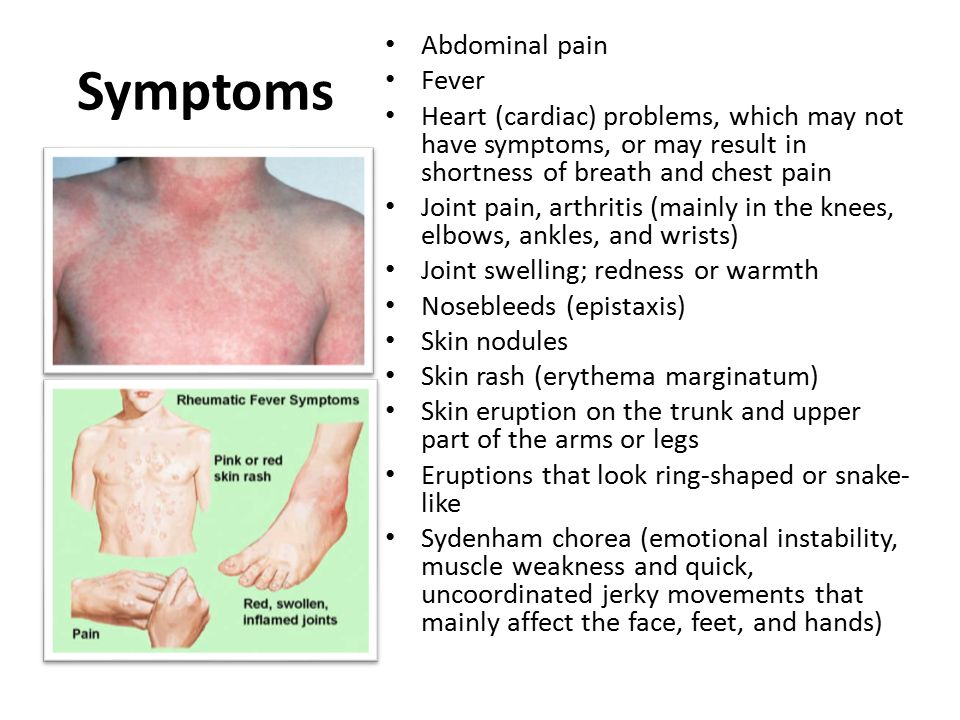 Rheumatic Fever. Rheumatic fever is an inflammatory disease that may  develop after an infection with Streptococcus bacteria (such as strep  throat or scarlet. - ppt download