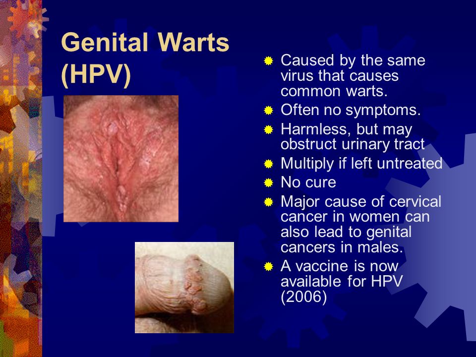 ce suflare urat cu viermi papilloma of uvula icd 10