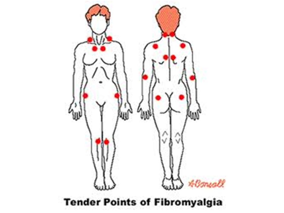 18 болезненный. Фибромиалгия болевые точки. Фибромиалгия точки. 18 Болевых точек при фибромиалгии. Фибромиалгия триггерные точки.