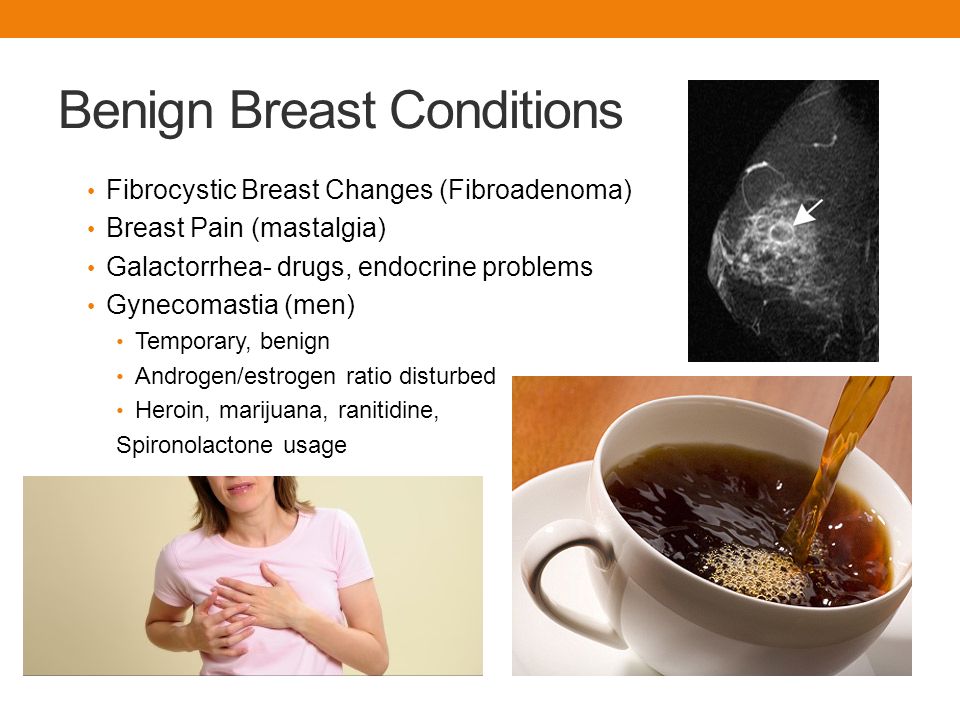 spironolactone fibrocystic breast Spironolactone fibrocystic breast