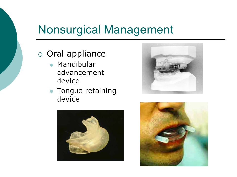 Nonsurgical Management  Oral appliance Mandibular advancement device Tongue retaining device