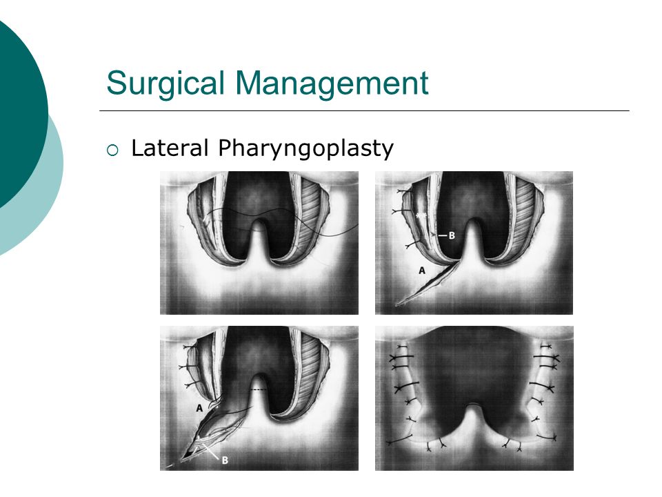 Surgical Management  Lateral Pharyngoplasty