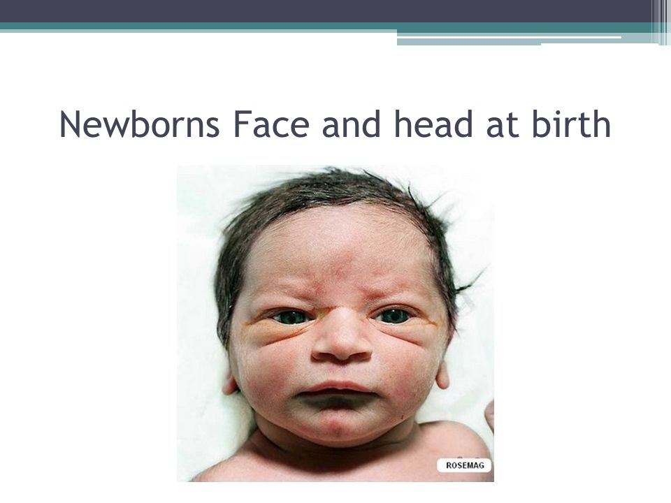 Newborns Face and head at birth