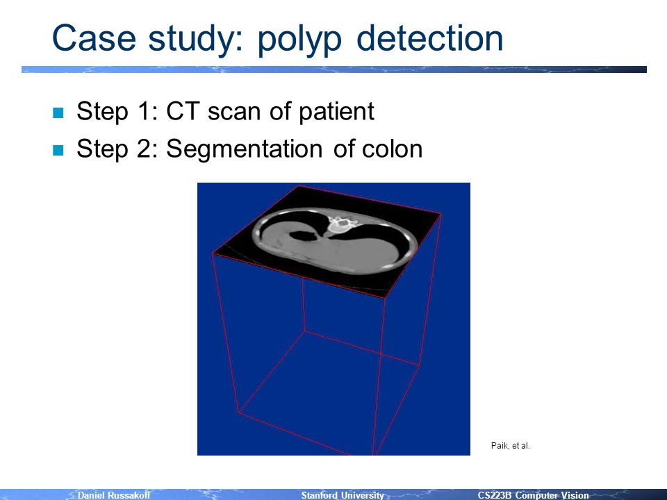 Daniel Russakoff Stanford University CS223B Computer Vision Case study: polyp detection n Step 1: CT scan of patient n Step 2: Segmentation of colon Paik, et al.