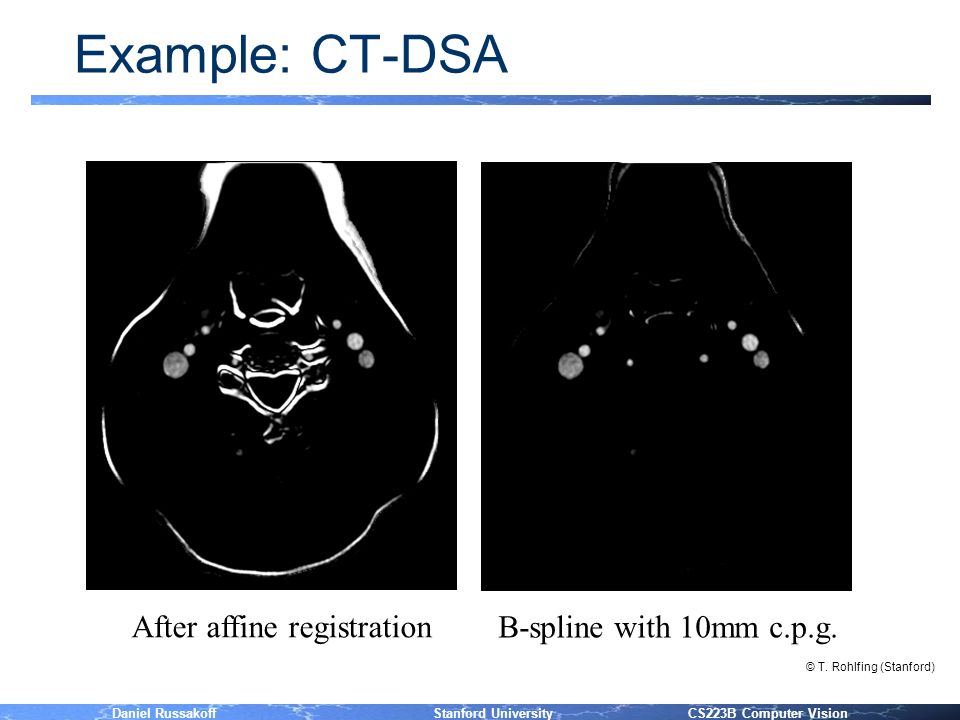 Daniel Russakoff Stanford University CS223B Computer Vision Example: CT-DSA After affine registration B-spline with 10mm c.p.g.