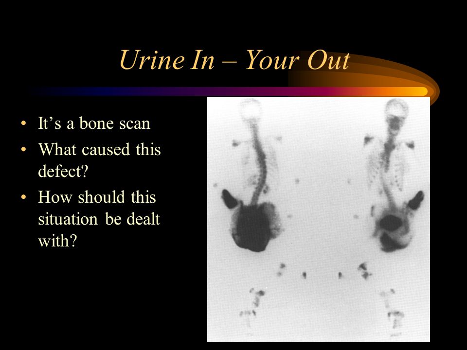 Urine In – Your Out It’s a bone scan What caused this defect.