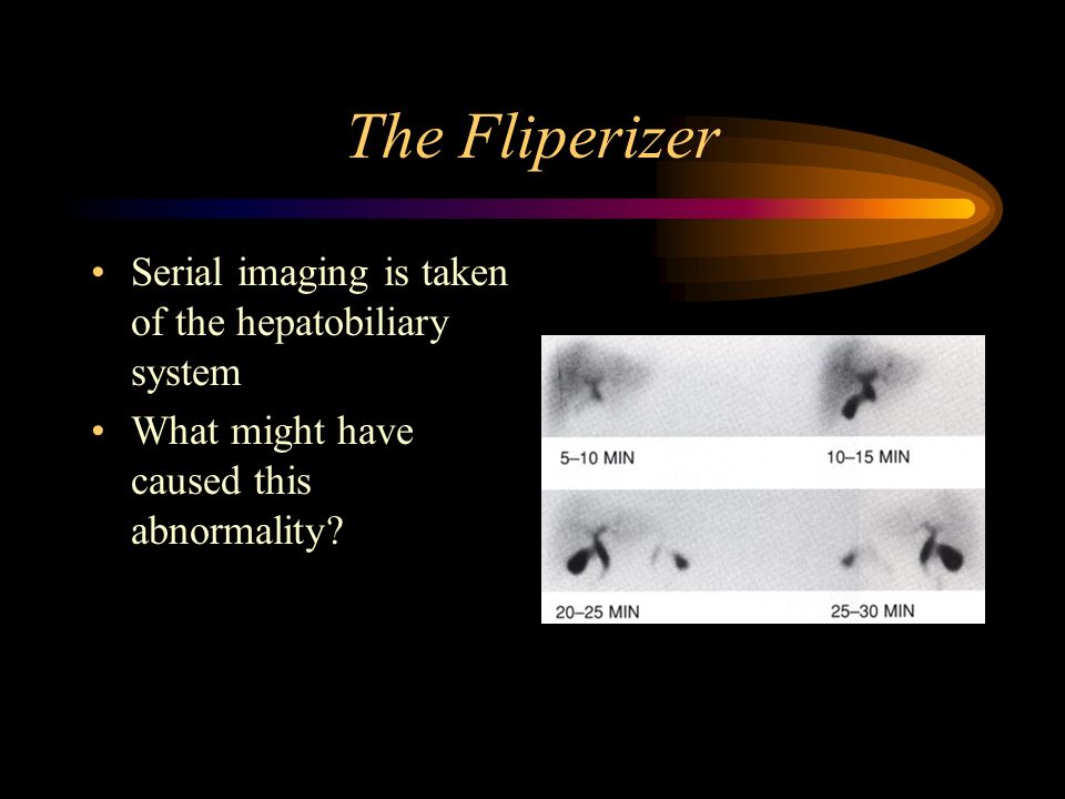 The Fliperizer Serial imaging is taken of the hepatobiliary system What might have caused this abnormality