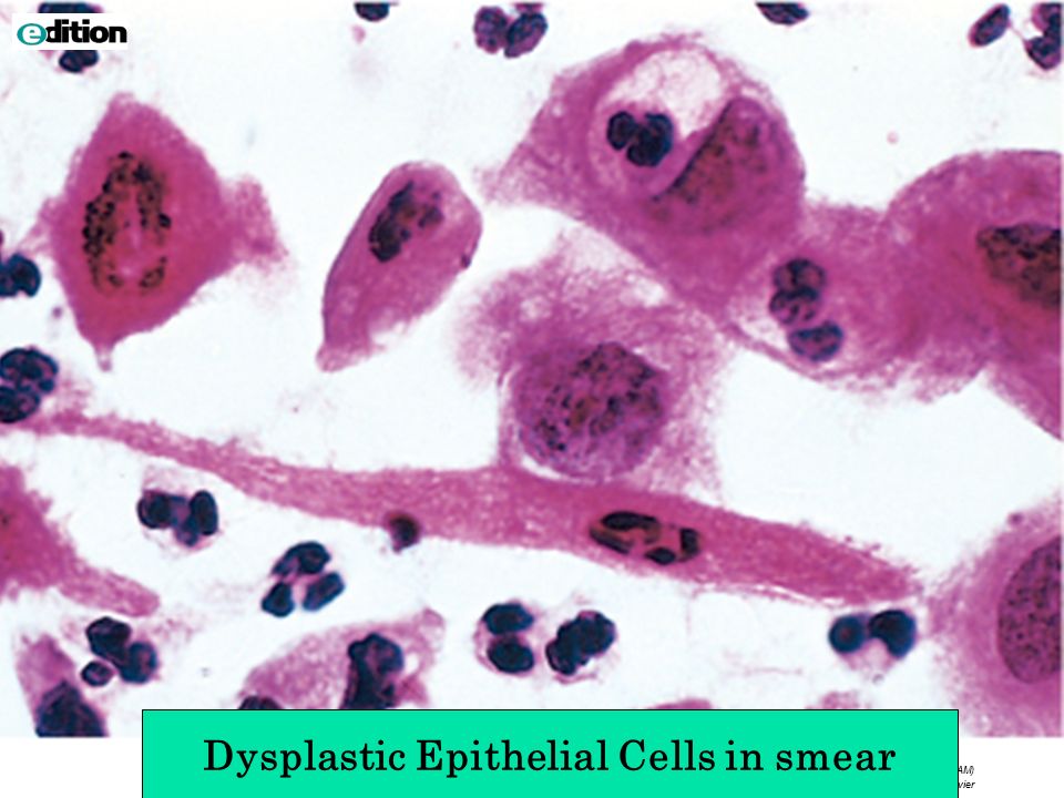 Downloaded from: Robbins & Cotran Pathologic Basis of Disease (on 18 December :36 AM) © 2005 Elsevier Dysplastic Epithelial Cells in smear