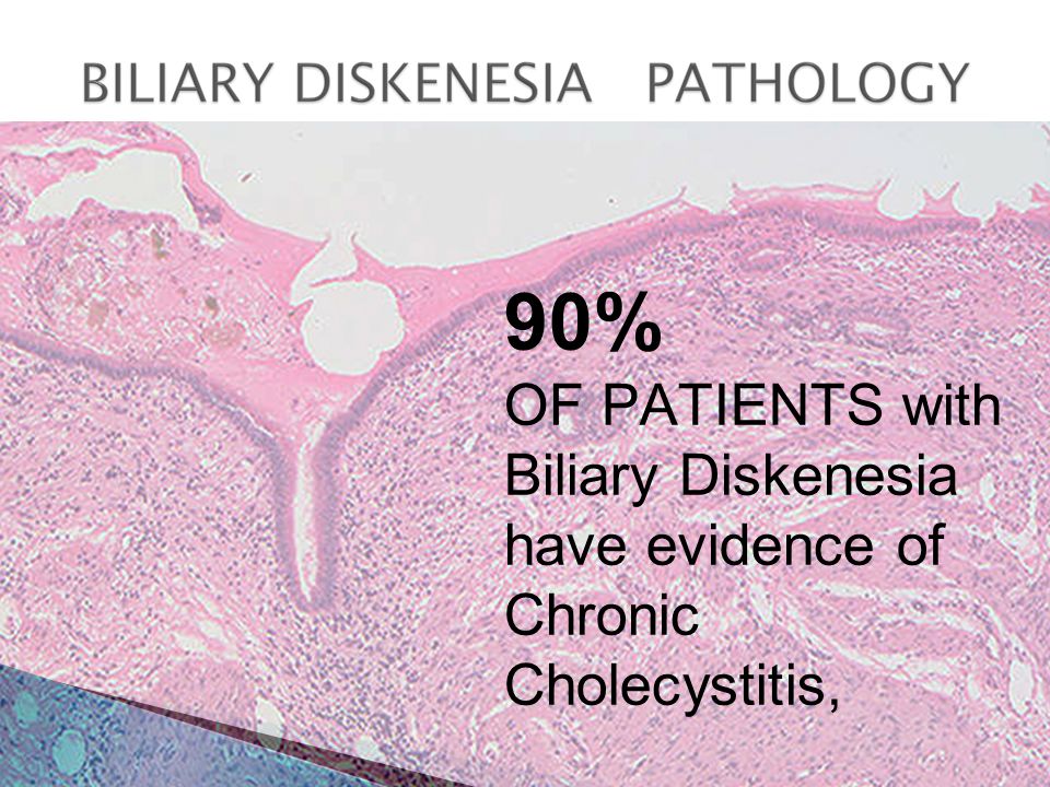90% OF PATIENTS with Biliary Diskenesia have evidence of Chronic Cholecystitis,