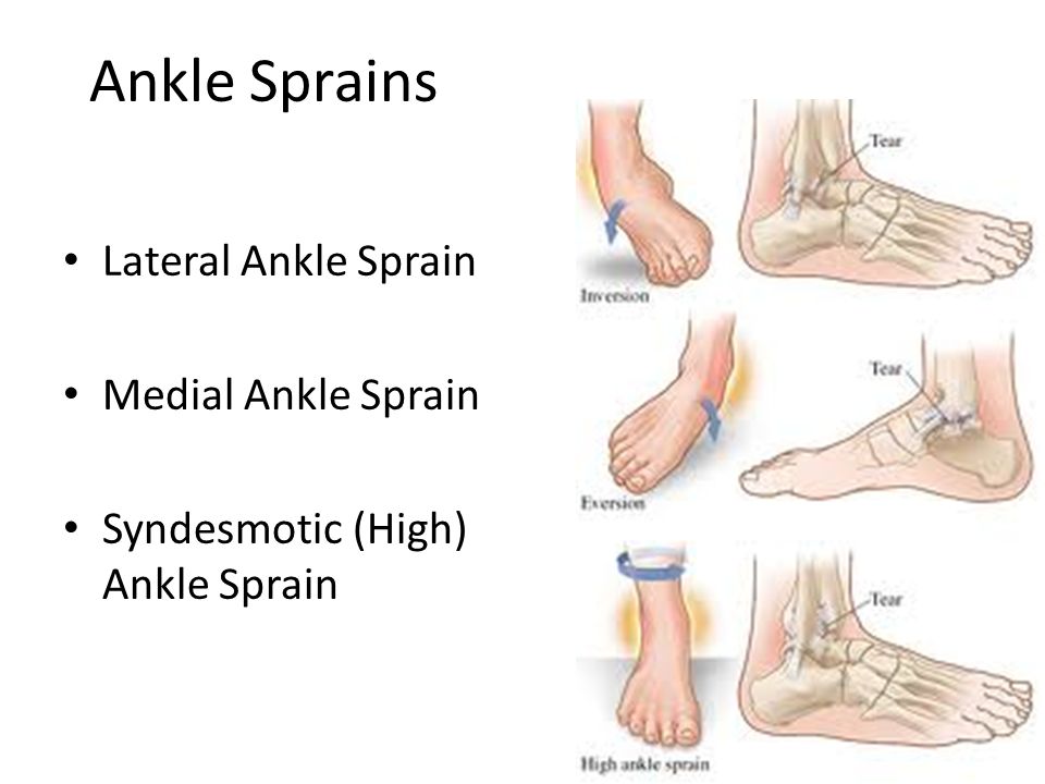 Ankle Sprains Lateral Ankle Sprain Medial Ankle Sprain Syndesmotic (High).....