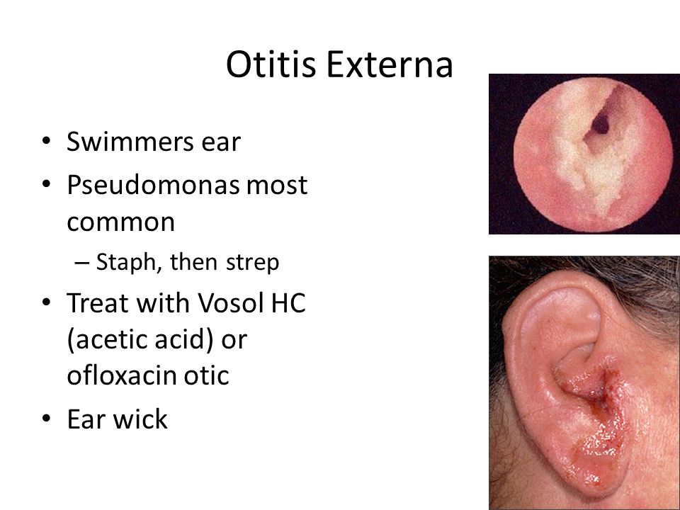 otitis-externa-and-facial-swelling