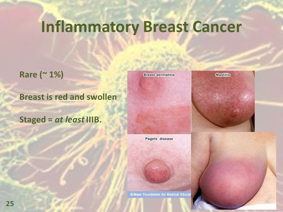 Picture of inflammatory breast cancer, amateur missouri porn