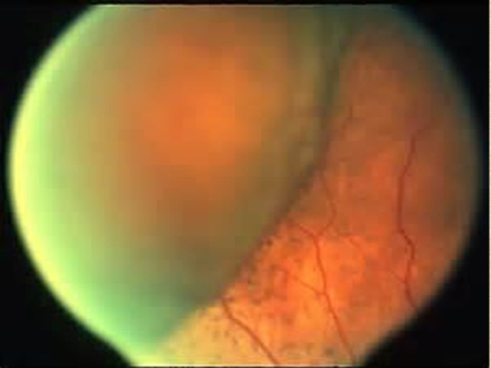 6 Choroidal Hemorrhage Occurs In 3 Of ICCE 22 Nucleus Expression ECCE 004 Phaco Surgery And 073 Glaucoma Filtering 6 Choroidal Hemorrhage Occurs In 3 Of ICCE 22 Nucleus Expression ECCE 004 Phaco Surgery And 073 Glaucoma Filtering