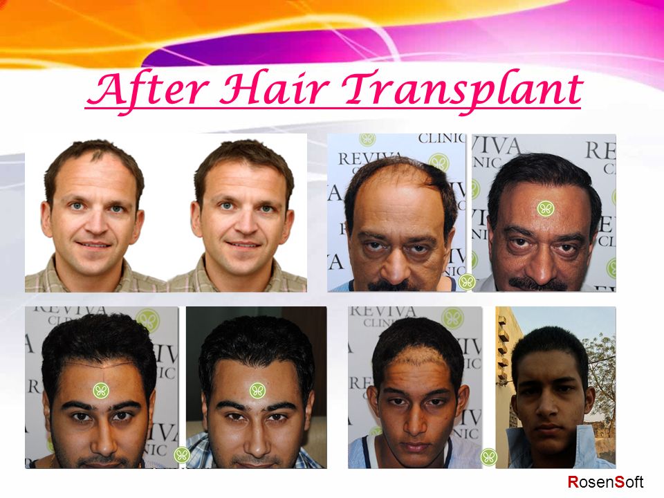 THE HAIR WORLD Clinic  There is One Most Important Factor in the Success  of Hair Transplant Surgery is the Training and Care