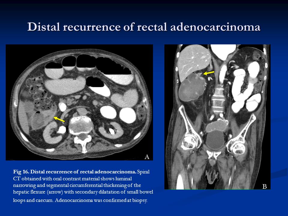 Distal recurrence of rectal adenocarcinoma A B Fig 16.
