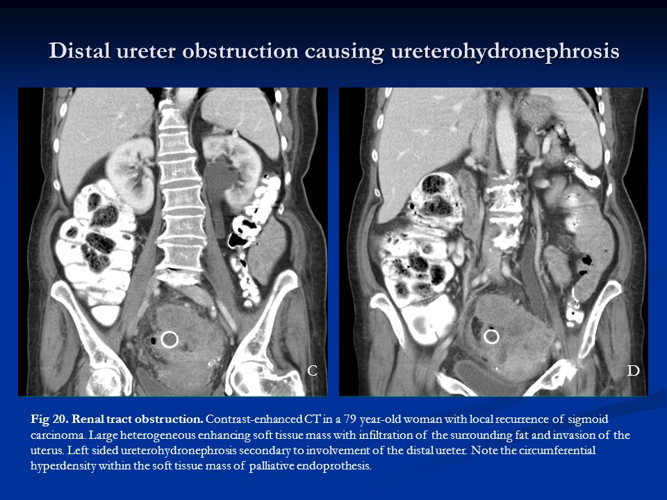 Distal ureter obstruction causing ureterohydronephrosis Fig 20.