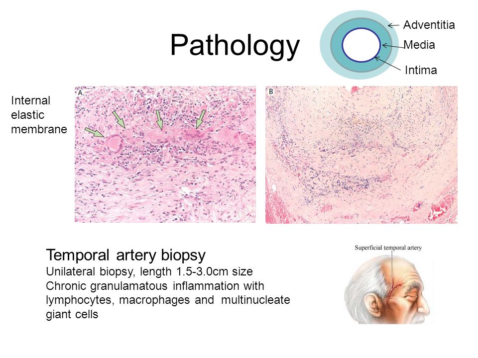 Pathology Temporal artery biopsy Unilateral biopsy, length cm size Chronic granulamatous inflammation with lymphocytes, macrophages and multinucleate giant cells Internal elastic membrane Adventitia Media Intima
