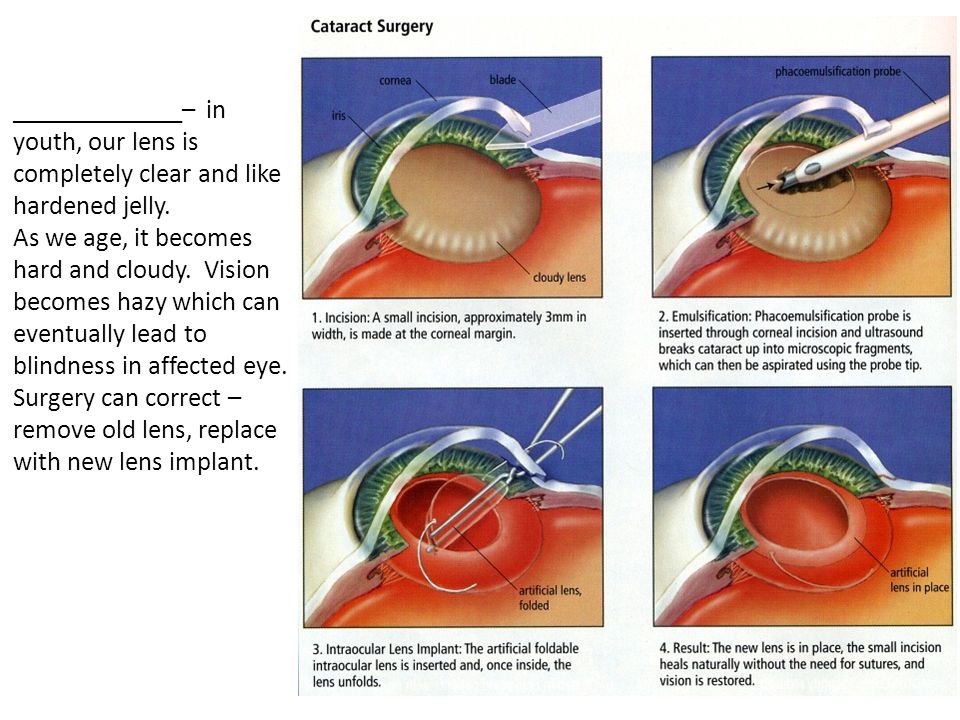 Катаракта операция clinicaspectr ru. Катаракта факоэмульсификация. Заднекапсульная катаракта. Ход операции по катаракте.