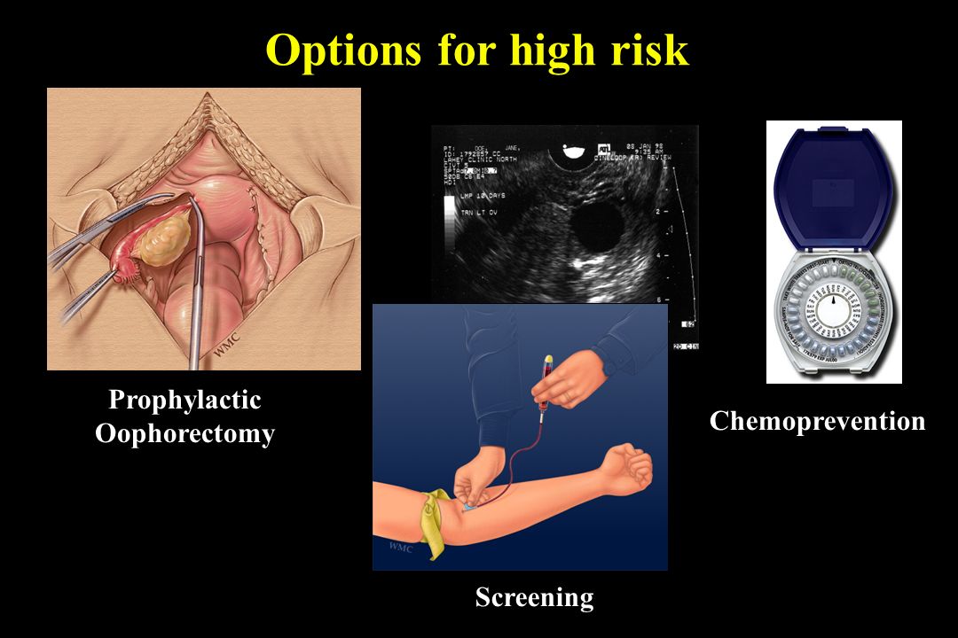 Prophylactic Oophorectomy Screening Chemoprevention Options for high risk