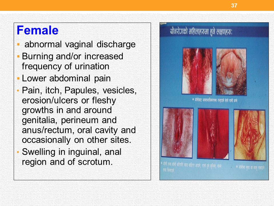 Vaginal Discharges