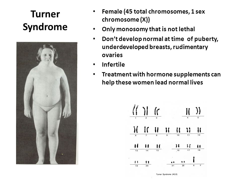 Turner Syndrome Female (45 total chromosomes, 1 sex chromosome (X)