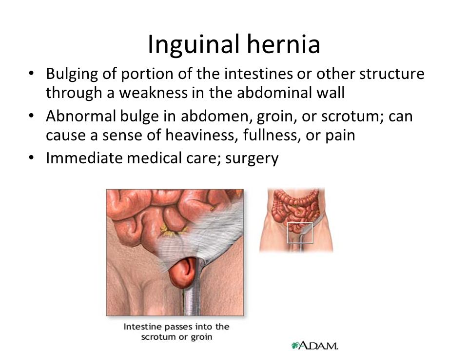 Hernia en el testiculo sintomas