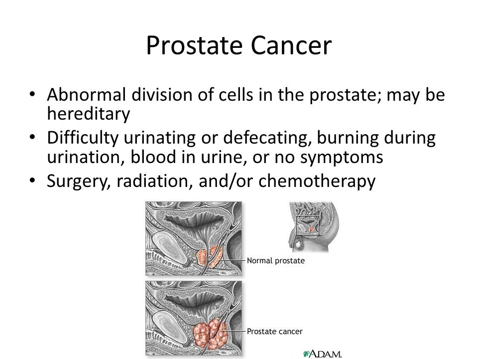 Would prostate cancer show up in a blood test