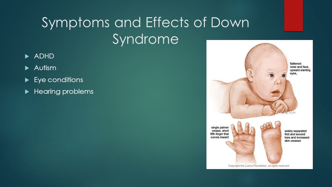 Presentation on theme: "Down Syndrome. ? 