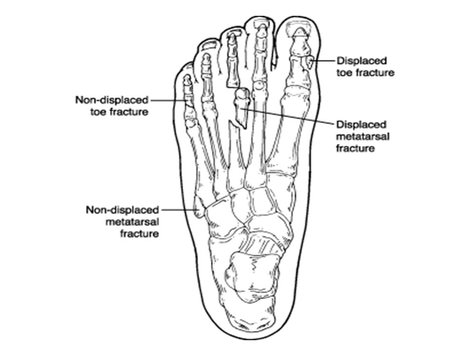 Fracturas dedos del pie