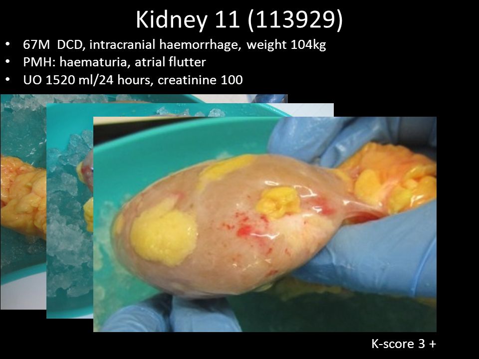 Kidney 11 (113929) 67M DCD, intracranial haemorrhage, weight 104kg PMH: haematuria, atrial flutter UO 1520 ml/24 hours, creatinine 100 K-score 3 +