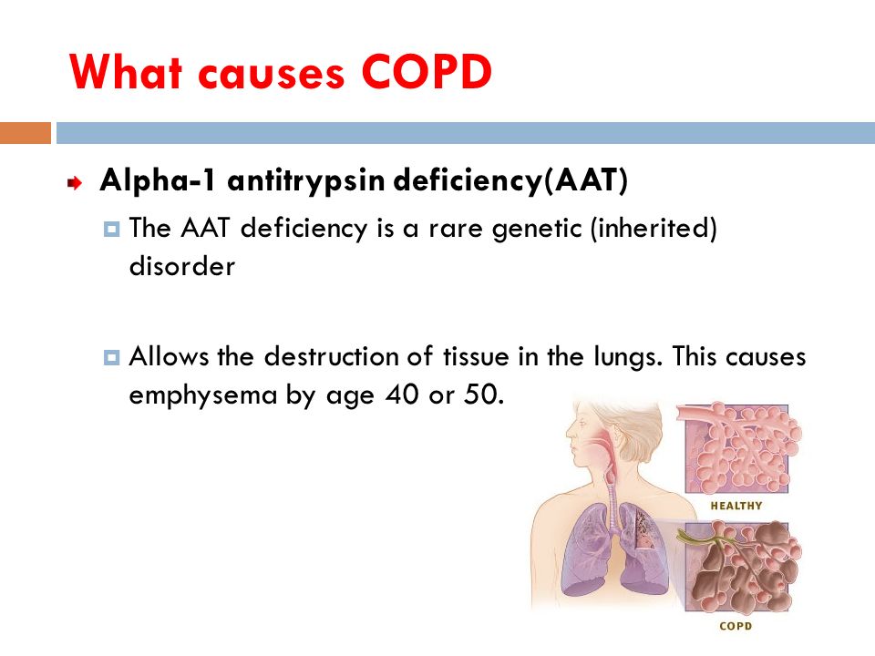 What causes COPD Alpha-1 antitrypsin deficiency(AAT)  The AAT deficiency is a rare genetic (inherited) disorder  Allows the destruction of tissue in the lungs.