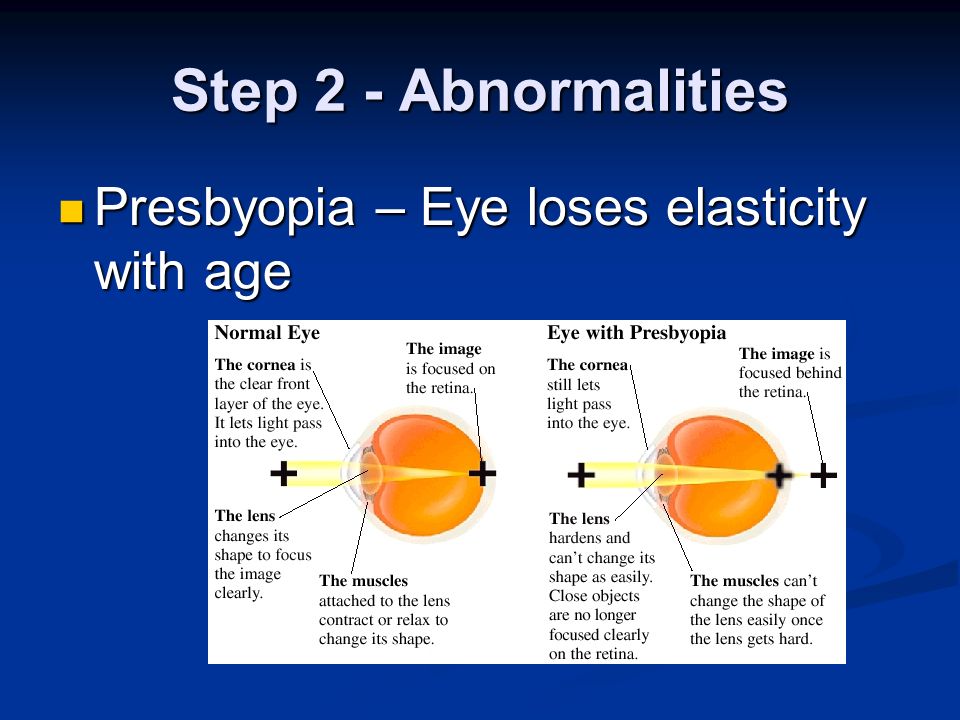 Step 2 - Abnormalities Presbyopia – Eye loses elasticity with age Presbyopia – Eye loses elasticity with age