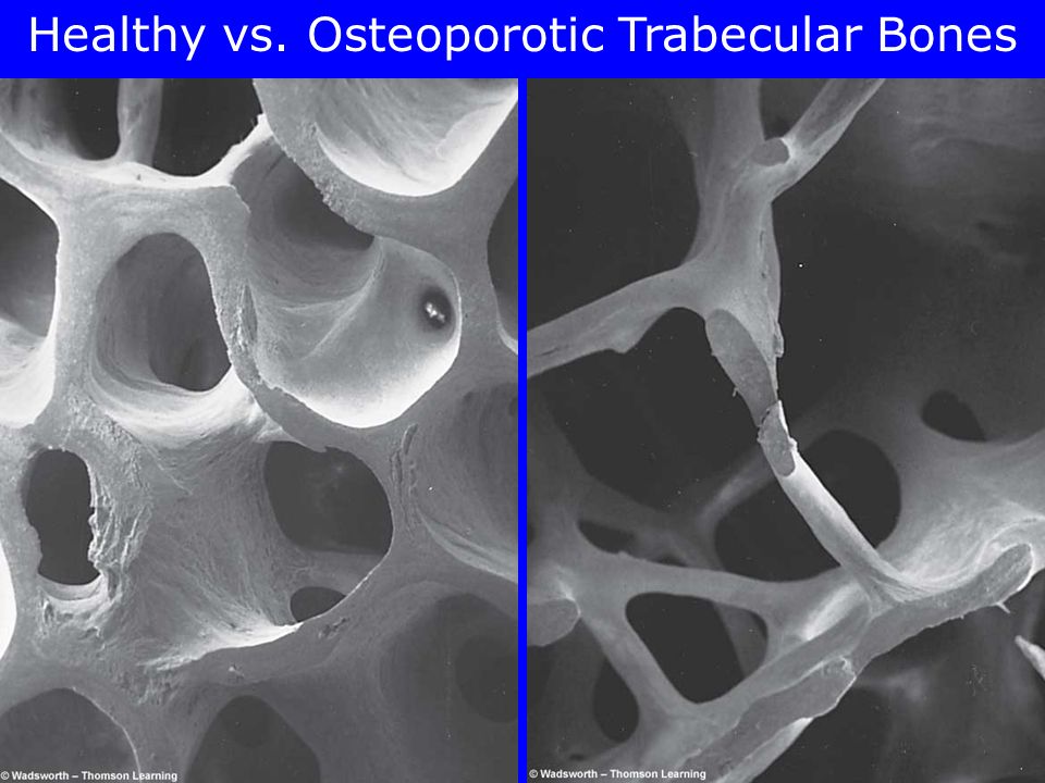 Osteoporosis And Calcium Bone development and disintegration –Cortical bone –Trabecular bone Copyright 2005 Wadsworth Group, a division of Thomson Learning