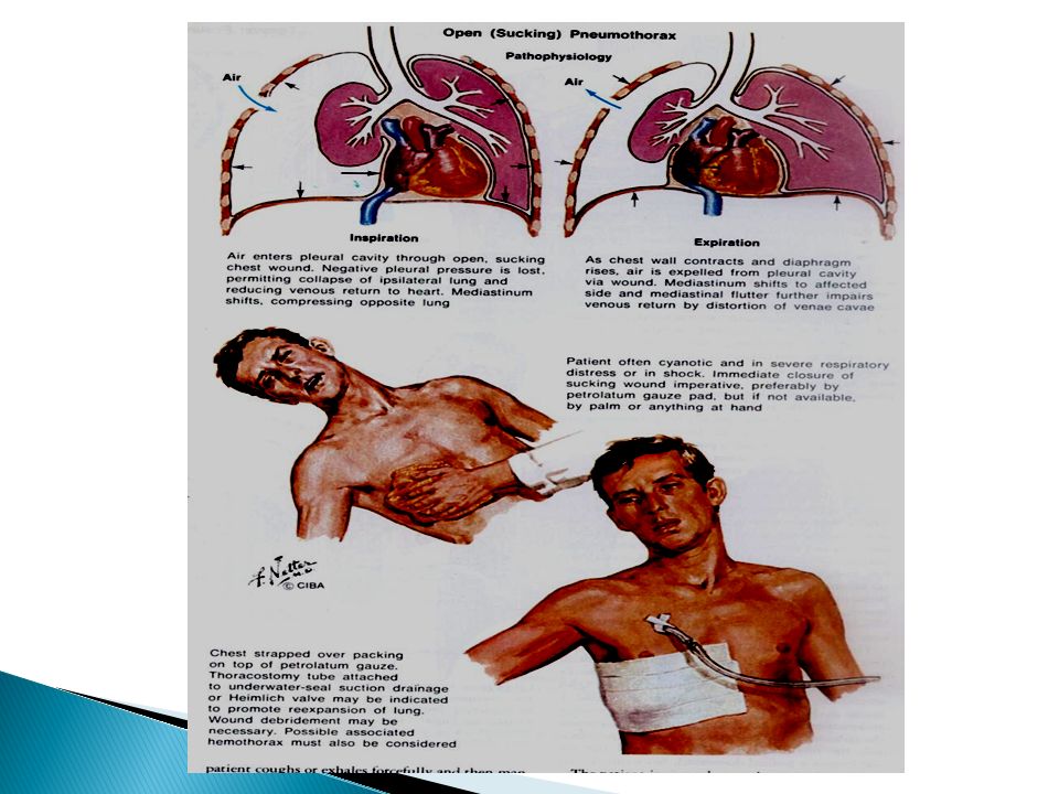 Pneumothorax  Haemothorax  PPT