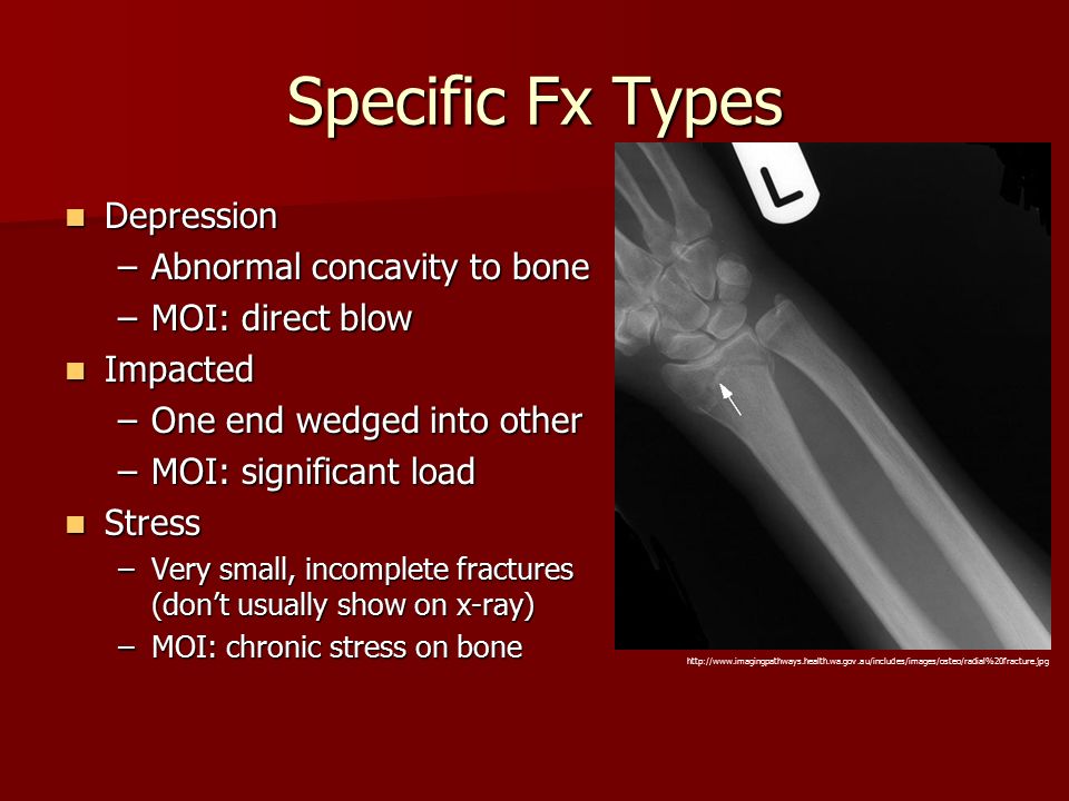 Specific Fx Types Depression Depression –Abnormal concavity to bone –MOI: direct blow Impacted Impacted –One end wedged into other –MOI: significant load Stress Stress –Very small, incomplete fractures (don’t usually show on x-ray) –MOI: chronic stress on bone