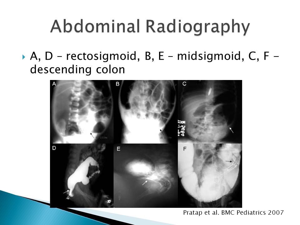  A, D – rectosigmoid, B, E – midsigmoid, C, F - descending colon Pratap et al. BMC Pediatrics 2007